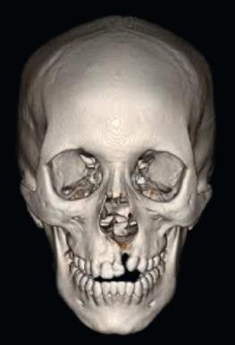 FIG. 3.5.1, Complete clefts of the lip or lip and palate disrupt all layers of tissues, including bone. In this three-dimensional CT scan reconstruction, the left unilateral complete cleft is easily identified. This defect disrupts the continuity of the maxillary arch, fails to provide bone stock for erupting adult dentition, and allows for collapse of the lesser alveolar segment. Alveolar bone grafting, in conjunction with orthodontic alignment, aims to correct these problems while closing soft tissue defects such as oronasal or labionasal fistulae.