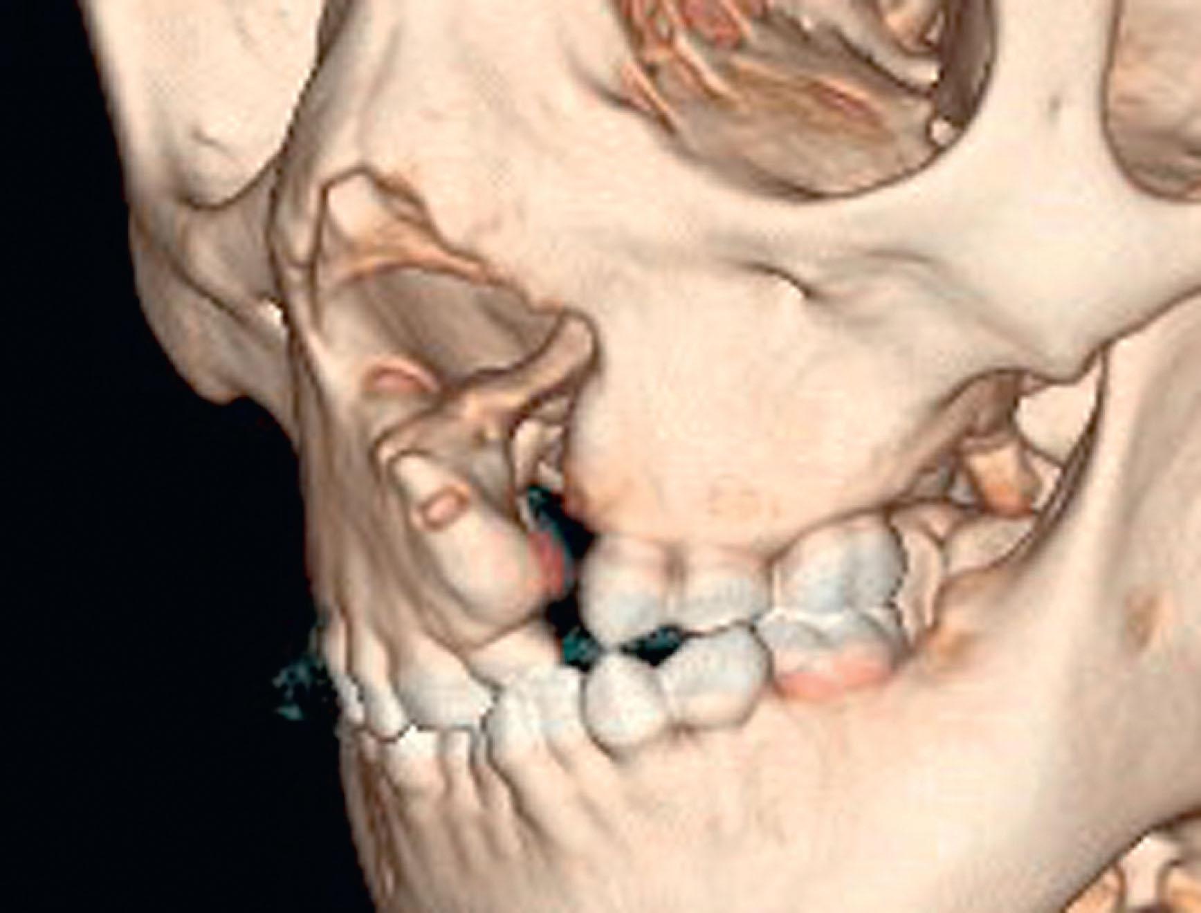 Figure 21.7.1, Bony anatomy of an untreated unilateral cleft lip and palate in a 4-year-old. The lateral piriform rim is hypoplastic, increasing the width of the piriform opening on the cleft side, creating a tornado-shaped defect. The maxillary nasal crest is deviated away from the cleft, carrying the bony septum with it. The collapse of the ungrafted maxillary arch is apparent with a lingual crossbite of the lesser segment.