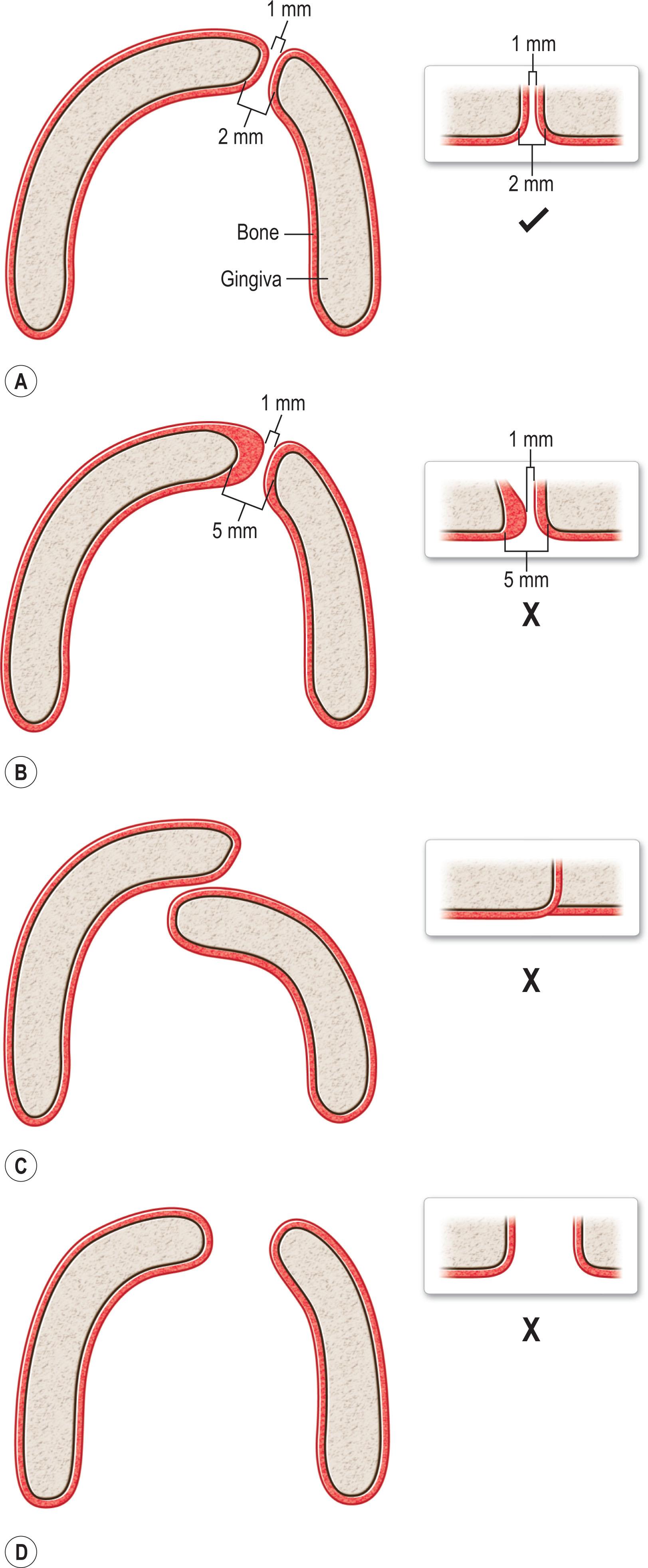 Figure 21.7.2, (A) An appropriately molded unilateral alveolar cleft candidate for gingivoperiosteoplasty (GPP). There is parallel alignment of the alveolar cleft edges with a smooth arch form. (B) Gingival hypertrophy in the alveolar cleft is masking a bone gap that is too wide for a GPP. (C) A collapsed arch form not amenable to GPP. Although the edges are touching, the opposing bone segments within the cleft are not aligned for bone formation. (D) A mesenchymal-deficient arch form that should not undergo GPP. If this cleft was approximated with molding followed by a GPP that formed a bone fusion, it would unnaturally constrict the projection of the alveolar arch. Arch expansion with bone grafting of the alveolar gap is the indicated treatment.