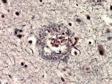 Figure 52-1, Neuritic plaques revealed by silver stain from cortex of patient with Alzheimer disease (×400).
