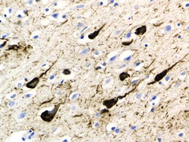 Figure 52-2, Neurofibrillary tangles in cortical section of brain from patient with Alzheimer disease.