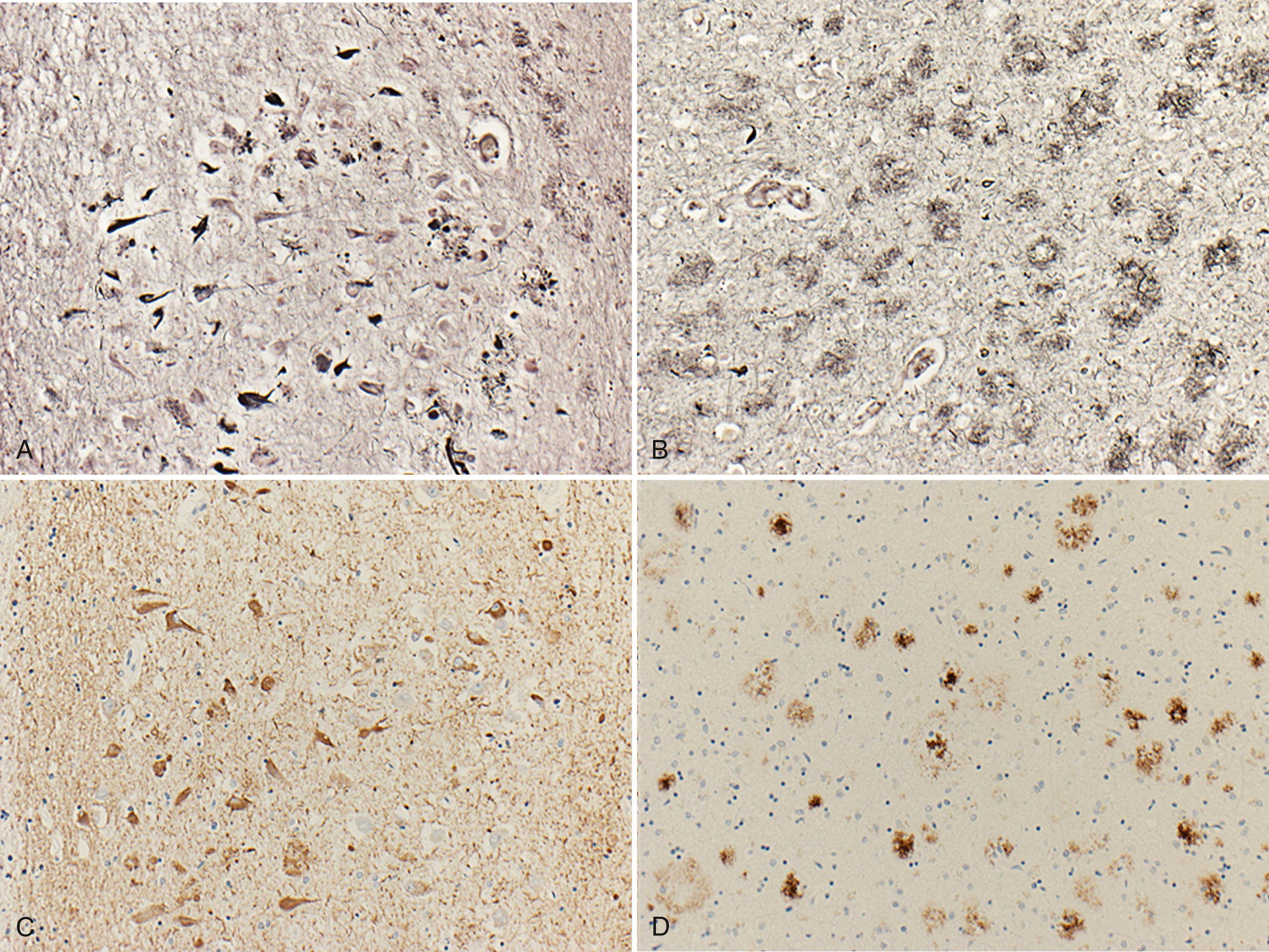 Fig. 95.12, Alzheimer Disease Pathology.