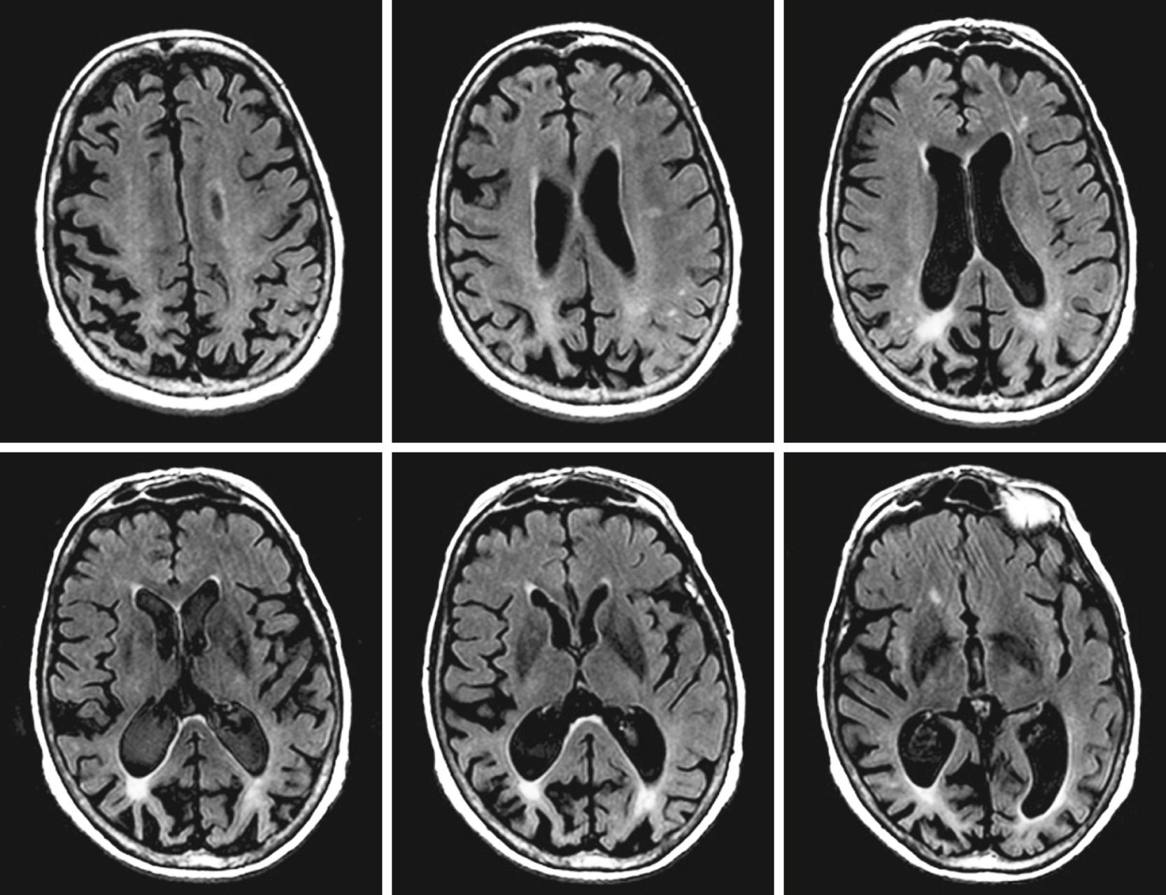 Fig. 95.3, T2 fluid-attenuated inversion recovery magnetic resonance imaging scans in a patient with posterior cortical atrophy revealing significant parietal and occipital atrophy.