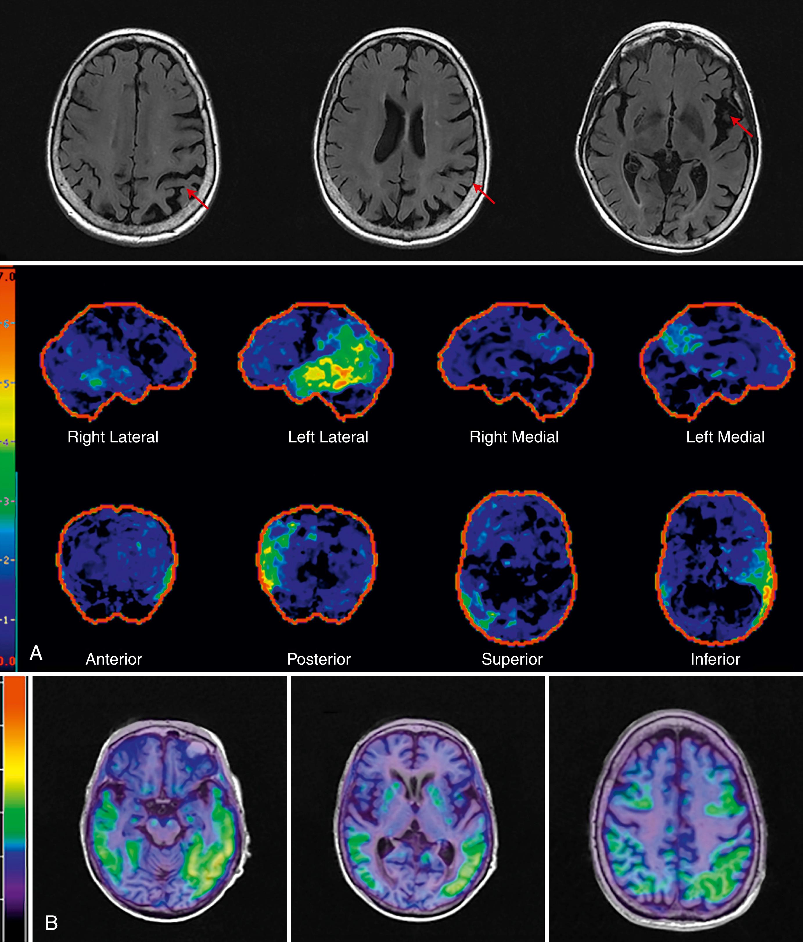 Fig. 95.5, A, Top row: T2 fluid-attenuated inversion recovery magnetic resonance imaging scans in a patient with logopenic primary progressive aphasia revealing significant left parietal and temporal atrophy (red arrows) . Bottom row: Fluorodeoxyglucose-positron emission tomography (PET) statistical stereotactic surface projection map (Cortex ID) in patient with logopenic aphasia demonstrating left temporal-parietal hypometabolism. B, Tau PET in logopenic primary progressive aphasia demonstrating left greater than right temporal and parietal tau deposition.