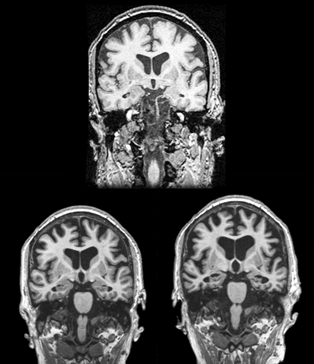 Fig. 95.7, Longitudinal coronal T1 magnetic resonance imaging in a patient that progressed from normal cognition to amnestic mild cognitive impairment (aMCI) to dementia due to Alzheimer disease (AD). Note progressive hippocampal and cortical atrophy. Top image: Normal cognition age 75. Bottom left image: aMCI age 81. Bottom right image: Dementia due to AD age 86.