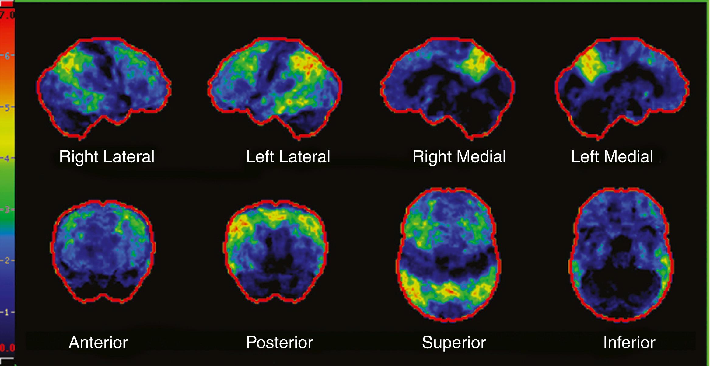 Fig. 95.8, Fluorodeoxyglucose-positron emission tomography statistical stereotactic surface projection map (Cortex ID) showing marked hypometabolism involving the temporal-parietal junction and posterior cingulate gyri which is relatively symmetric. Relative preservation of the frontal and occipital lobes consistent with Alzheimer disease dementia.