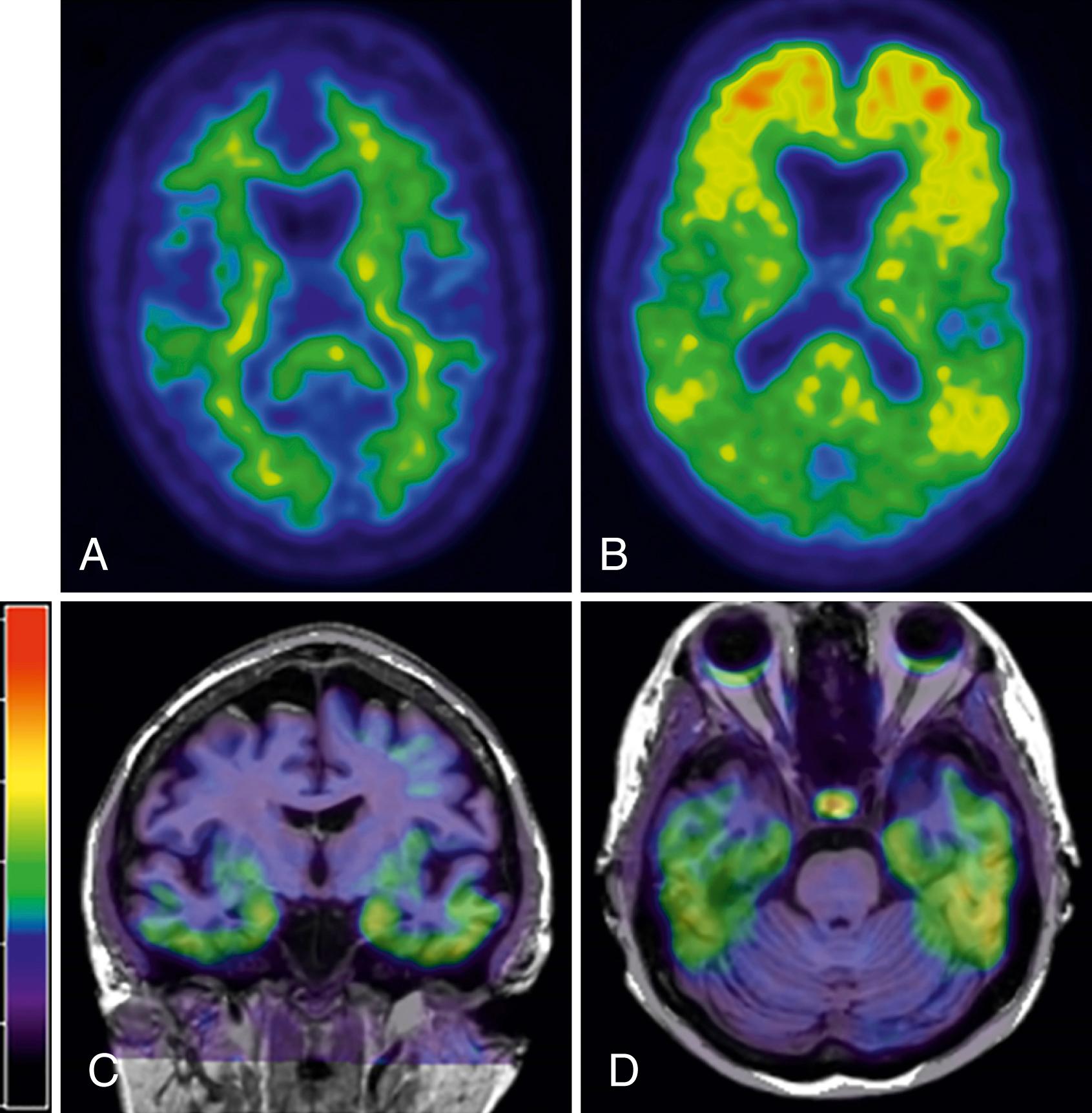 Fig. 95.9, Top Row: Amyloid Pittsburgh Compound B (PiB)-Positron Emission Tomography Imaging.