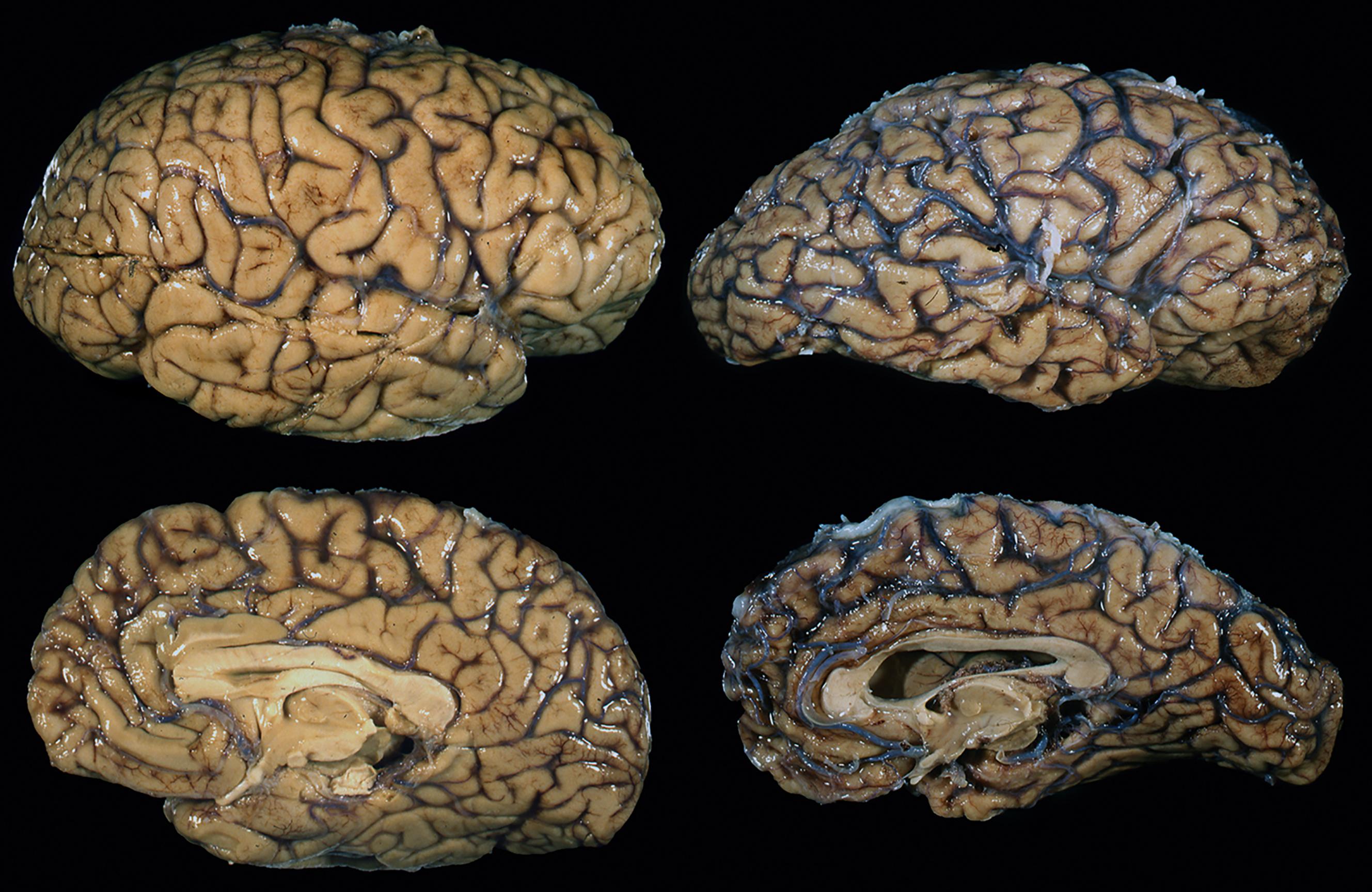 Fig. 4.5, External view of gross pathology in Alzheimer’s disease. Comparison of a brain with Alzheimer’s disease (right) with a healthy brain (left) . Note that the meningeal vessels are more prominent in the brain with Alzheimer’s disease because the brain gyri have shrunk, revealing the vessels.