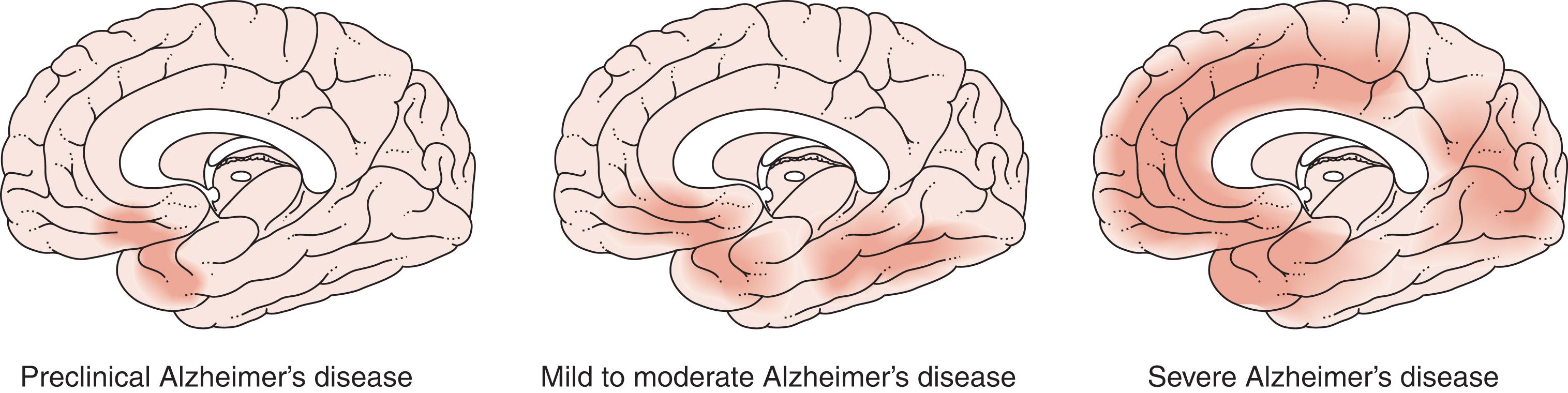 Fig. 4.7, Alzheimer’s disease spreads through the brain.