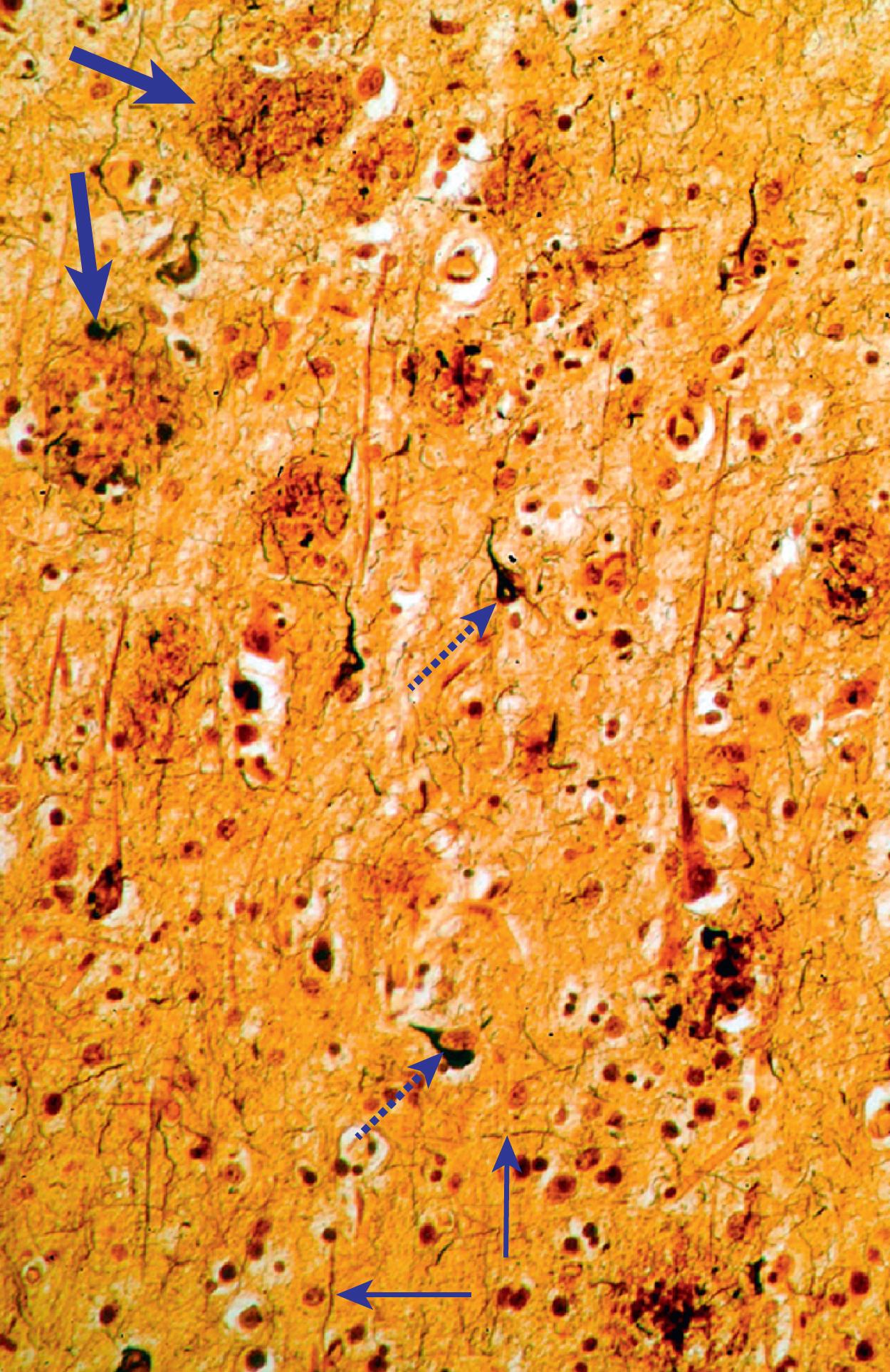 Fig. 4.9, Light microscopic view of Alzheimer’s pathology. Plaques (thick arrows) , tangles (dotted arrows) , and neuropil threads (thin arrows) in Alzheimer’s disease.