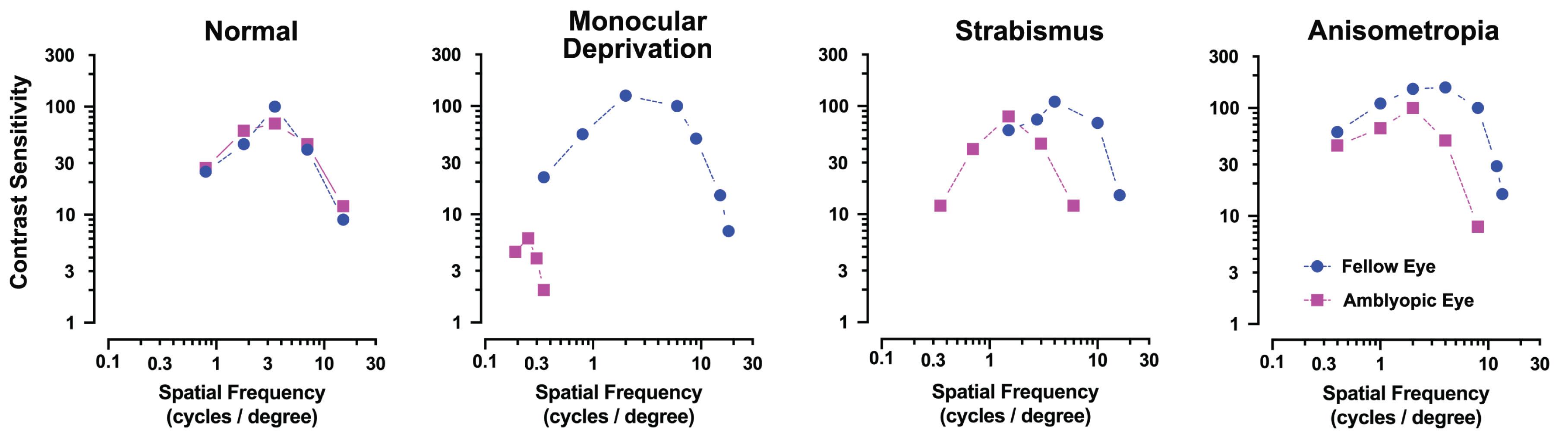 Fig. 11.11.3, Behavioral Measurements of Contrast Sensitivity in Amblyopia.