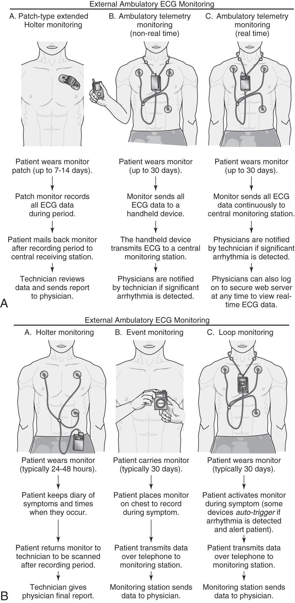 Fig. 6.1, A, Types of ambulatory electrocardiography (AECG) monitors currently available in clinical practice. B, Types of AECG monitors currently available in clinical practice. ECG, Electrocardiogram.