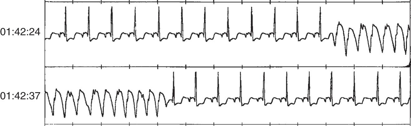 Fig. 6.3, Representative printout from an interrogated implantable loop recorder demonstrating a run of nonsustained ventricular tachycardia.