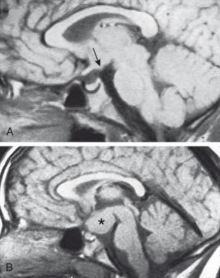 Figure 127.1, Hamartoma of the tuber cinereum causing precocious puberty.