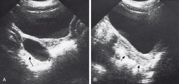 Figure 127.2, Autonomous estrogen-secreting ovarian cyst causing precocious puberty.