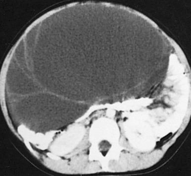 Figure 127.3, Granulosa cell tumor of the ovary causing precocious puberty.