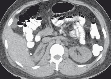 Figure 127.4, Congenital adrenal hyperplasia.