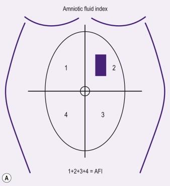 FIGURE 4-2, (A) Amniotic fluid measurement diagram. (B) Amniotic fluid measurement ultrasound.