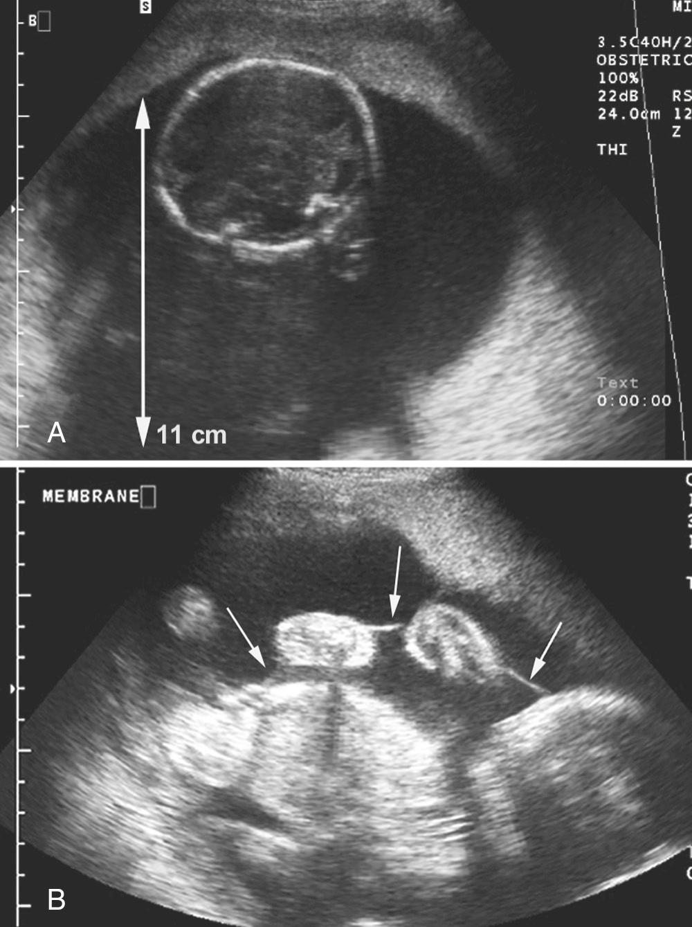 Fig. 24.4, Appearance of “stuck twin” in twin–twin transfusion syndrome. A, Note fetus appears suspended to the anterior wall of uterus surrounded by large fluid collection (polyhydramnios of second twin). The membranes surrounding this twin are not visible on ultrasound examination. B, Note the tightly adherent membranes ( arrows ) in the donor twin sac.