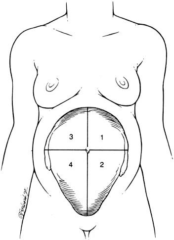FIG 20-3, Diagram of the division of the uterus into four equal quadrants for determination of the amniotic fluid index (AFI). With the patient supine and the ultrasound transducer perpendicular to the table, the vertical depth (measured in centimeters) of the largest amniotic fluid pocket free of umbilical cord in each quadrant is measured. AFI is calculated by summing these four measurements.