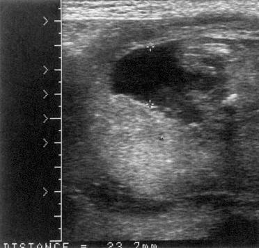 FIG 20-4, Normal amniotic fluid volume assessed by measurement of the largest single pocket of fluid. In this 22-week gestation, the largest vertical pocket of amniotic fluid, devoid of umbilical cord, is 24 mm.