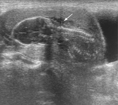 FIG 20-6, Sonogram of a fetus with renal agenesis. Virtually no amniotic fluid is seen. The fetus is “crowded” within the uterus. The only relatively anechoic space is occupied by the umbilical cord ( arrow ).