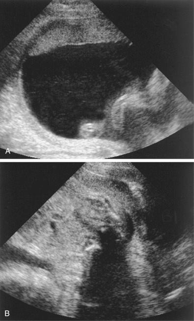 FIG 20-8, A, Sonogram of the fundic portion of the uterus in a second trimester pregnancy. Although this single large amniotic fluid pocket simulates polyhydramnios, it was the only area of amniotic fluid. B, Sonogram of the same patient in the mid- to lower uterine segment. No amniotic fluid is seen in this scan. If amniotic fluid volume had to be assessed on the basis of this image alone, it would be interpreted as oligohydramnios.