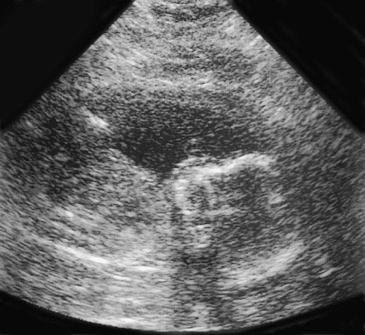 FIG 20-9, Sonogram in a moderately obese patient. Artifactual echoes within the amniotic fluid make the actual amniotic fluid less apparent.