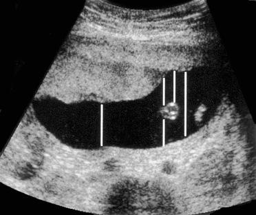 FIG 20-10, Sonogram of a second trimester pregnancy. Measurements of this amniotic fluid pocket might be made in a variety of locations by different examiners, and some examiners may choose not to use this pocket for measurement.