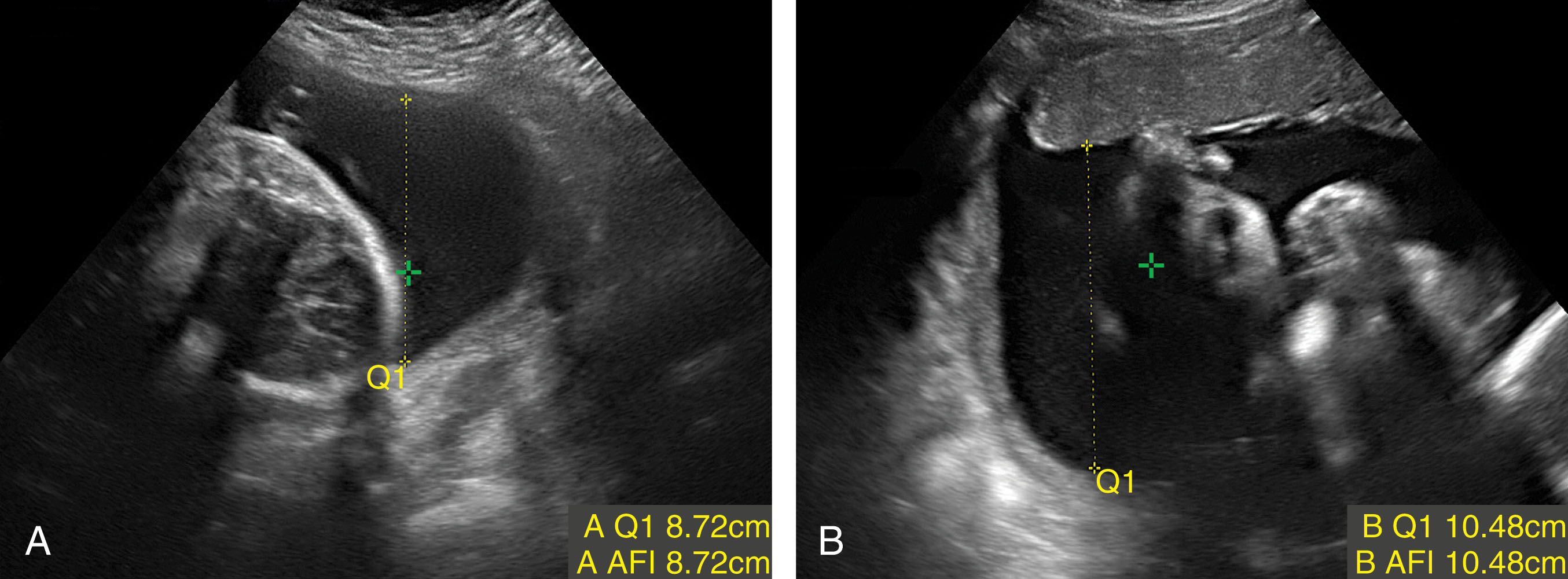 Fig. 58.11, Single vertical pocket measurements are used in this twin pregnancy at 30 weeks of gestation with polyhydramnios.