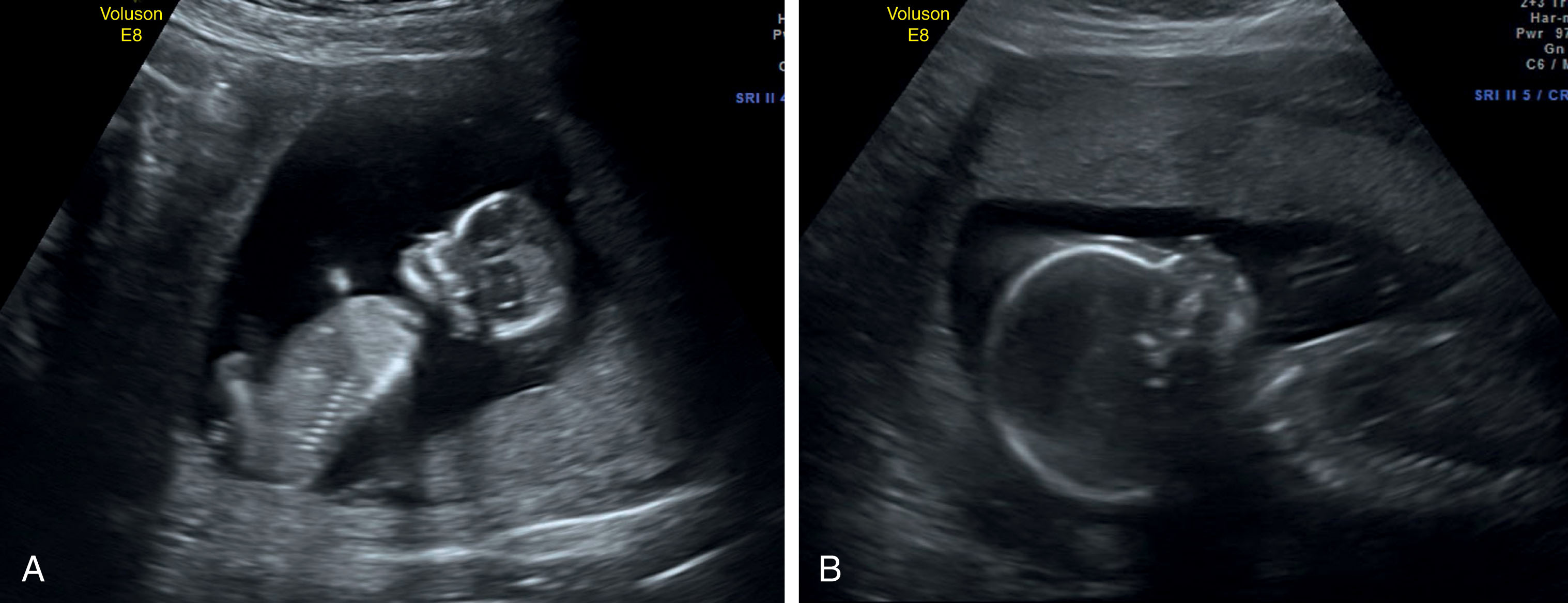 Fig. 58.3, (A) Amniotic fluid around a 13-week-old fetus in a sitting position. (B) Amniotic fluid around an 18-week-old fetus.