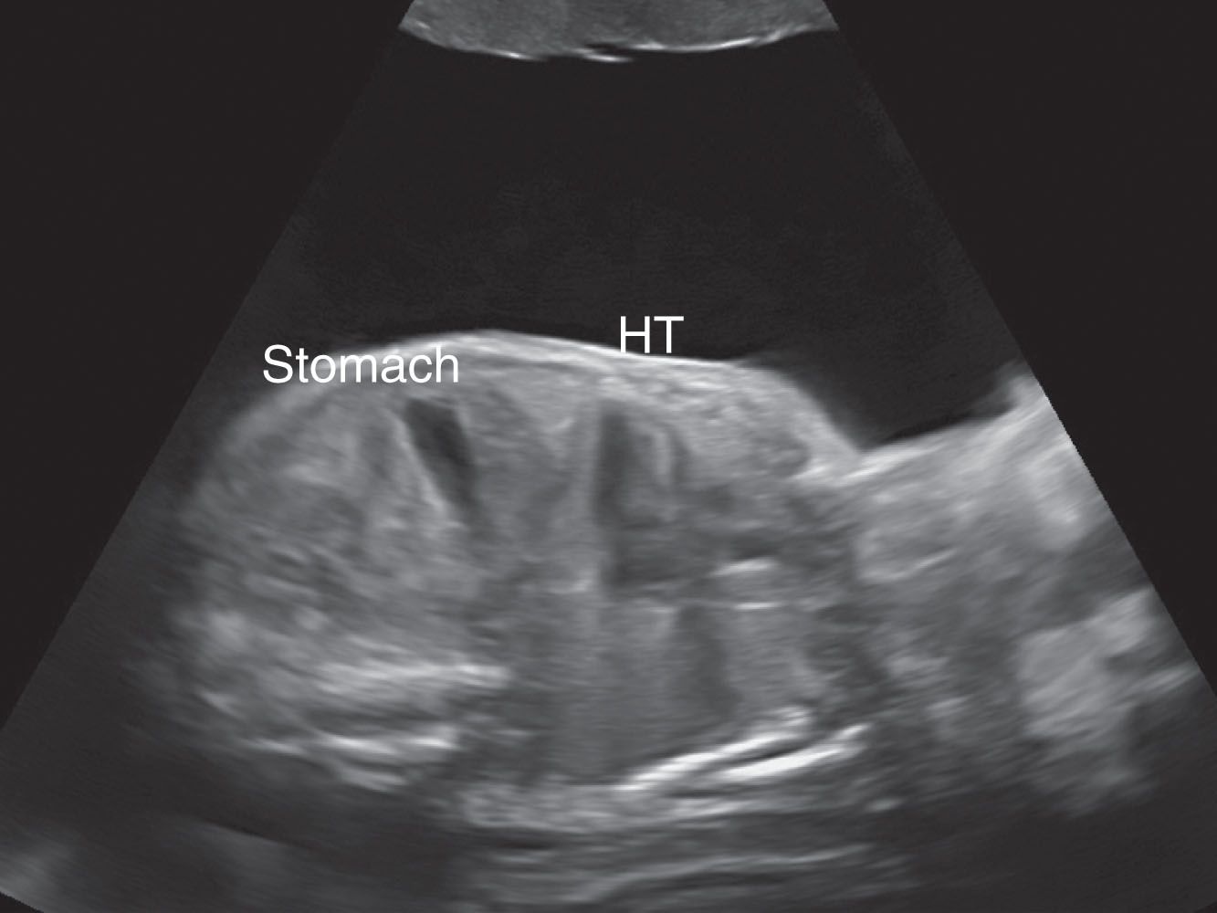 Fig. 58.5, Fetus presenting with severe polyhydramnios at 30 weeks of gestation. HT , Heart.