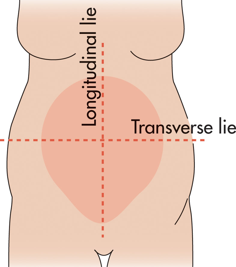 Fig. 58.6, The amniotic cavity is divided into quadrants by two imaginary lines perpendicular to each other. The largest pocket of fluid is measured in each quadrant.