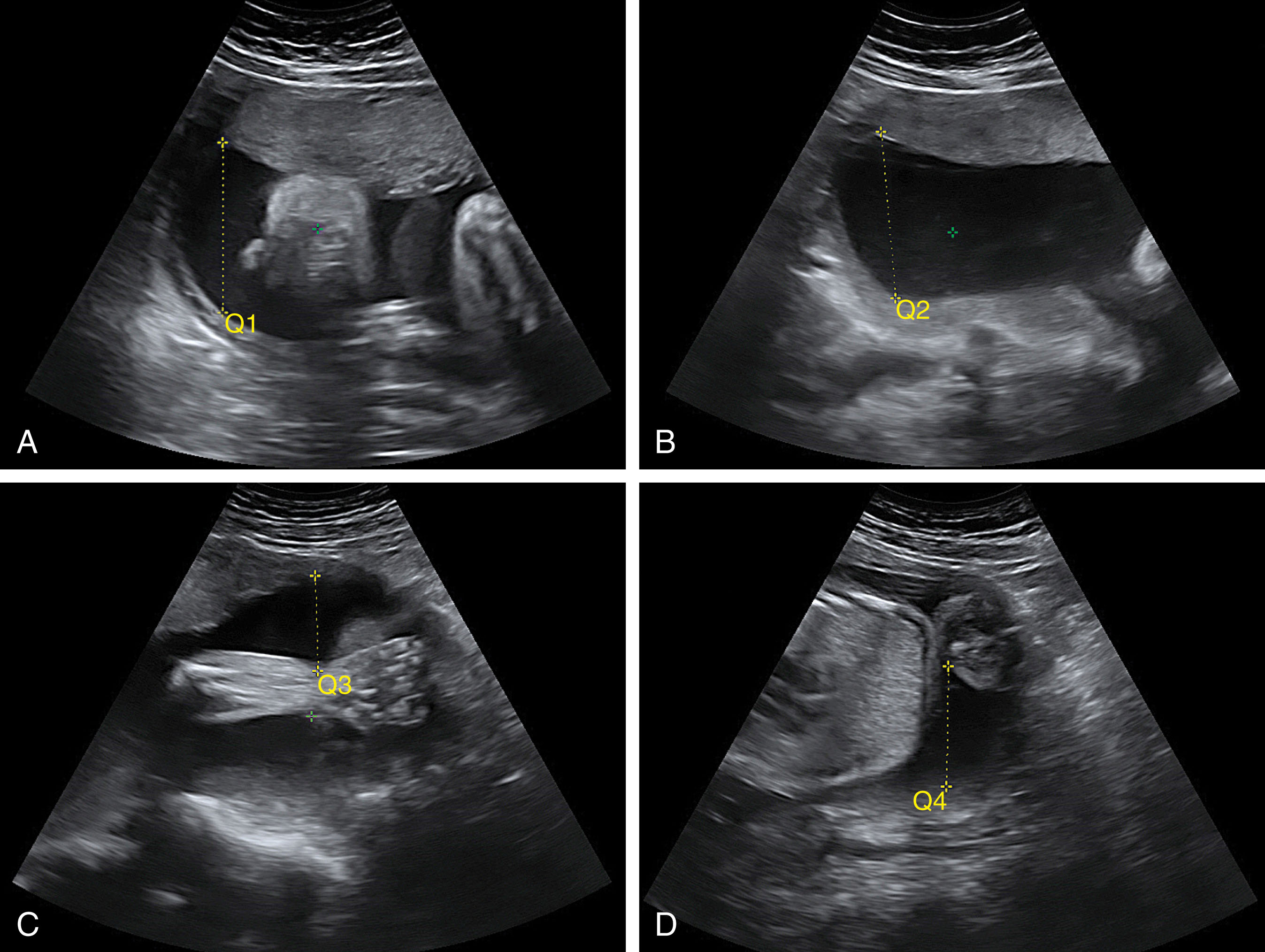 Fig. 58.7, The deepest vertical pocket is measured in each quadrant free of any fetal components.