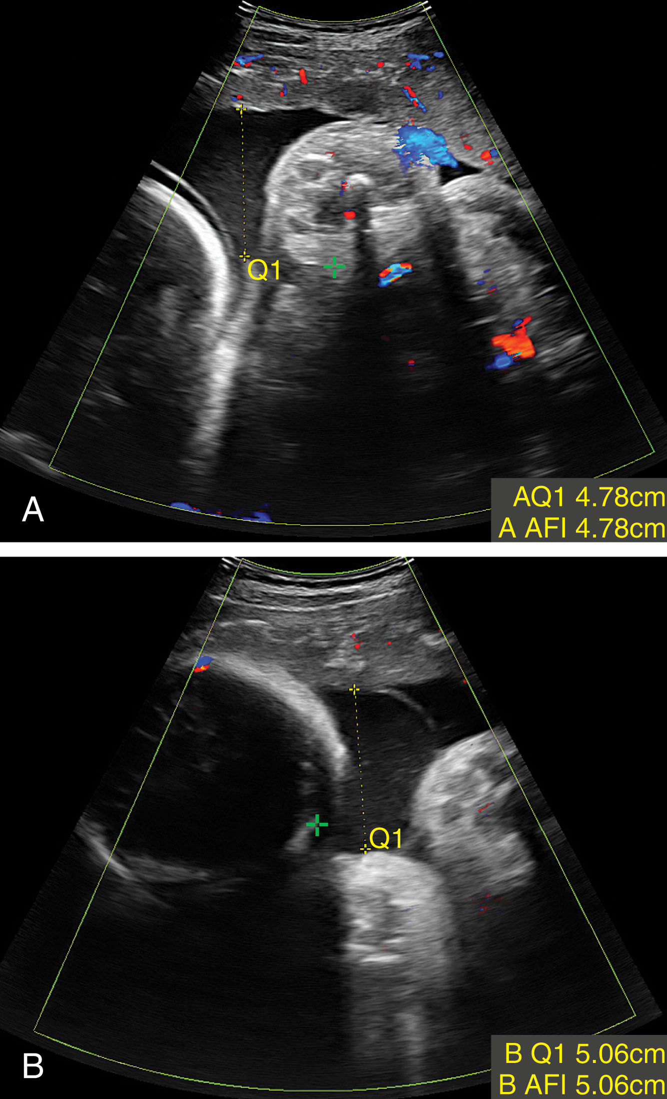 Fig. 58.10, (A) Measurement of the largest vertical pocket of fluid for twin A. Color Doppler is used to ensure the cord is not present within the pocket (+ indicates fetal body of twin A). (B) Measurement of the largest vertical pocket of fluid for twin B. Note the visualization of the dividing membrane (+ indicates fetal head of twin B).