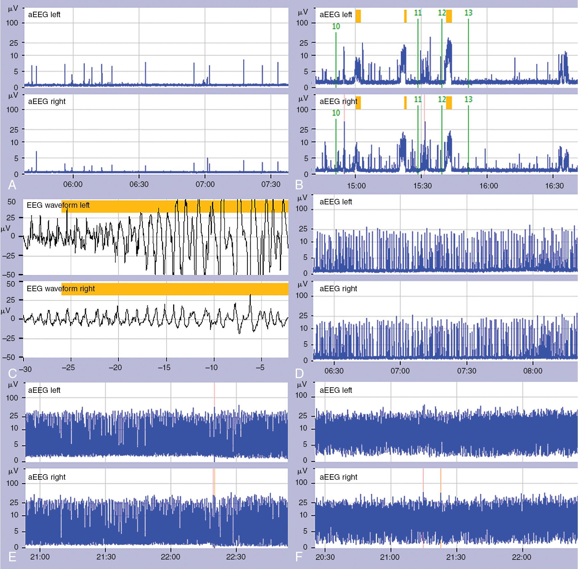 Fig. 14.1, A, Cooling was started at 3 hours after birth. B, Amplitude-integrated electroencephalogram (aEEG) at 18 hours after birth during cooling shows a flat trace pattern with seizures (indicated by the pink bars ). 10 , care; 11 , x-ray; 12+13 , midazolam is given. C, The raw EEG showing a typical ictal discharge with evolution in amplitude and frequency. D, A sparse burst suppression pattern is seen 36 hours after birth (during cooling). E, A dense burst suppression is seen 48 hours after birth. F, A discontinuous normal voltage pattern is seen 72 hours after birth.