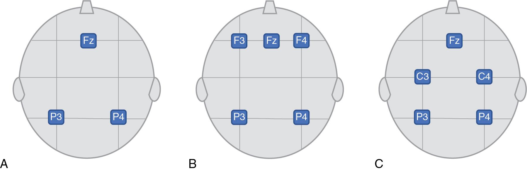 Fig. 14.2, Examples of electrode position in single channel aEEG using P3 and P4 (A) atypical two channel with F3-P3/F4-P4 (B) and more commonly used two channel with C3-P3/C4-P4 (C)