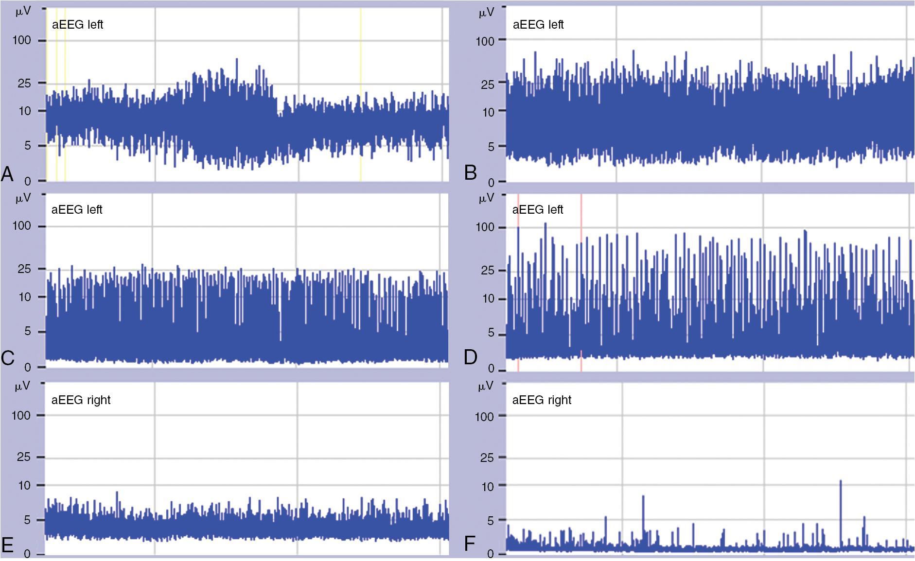 Fig. 14.3, A, Continuous normal voltage pattern with sleep-wake cycling. B, Discontinuous normal voltage pattern. C, Dense burst suppression. D, Sparse burst suppression pattern. E, Continuous low-voltage pattern. F, Flat trace pattern. aEEG , Amplitude-integrated electroencephalogram.