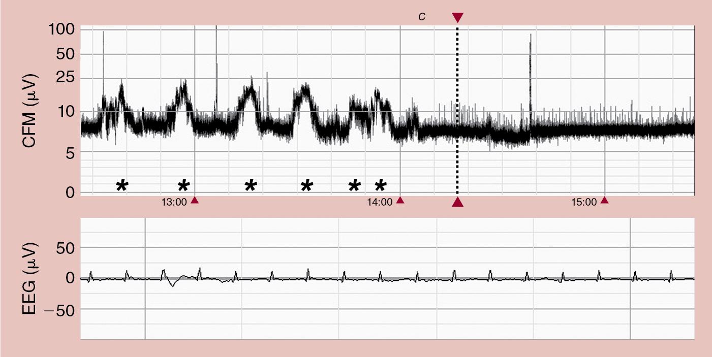 Fig. 14.4, The patient was born at full-term via an emergency cesarean section. Sinusoidal cardiotocography was seen. Arterial umbilical pH was 6.70, and the first arterial lactate level was 30 mmol/L. Upper panel, drift of the baseline with seizures (indicated by *). Lower panel, raw EEG shows electrocardiogram artifact. The loading dose of lidocaine was given at point C. CFM , Cerebral function monitor; EEG , electroencephalogram.