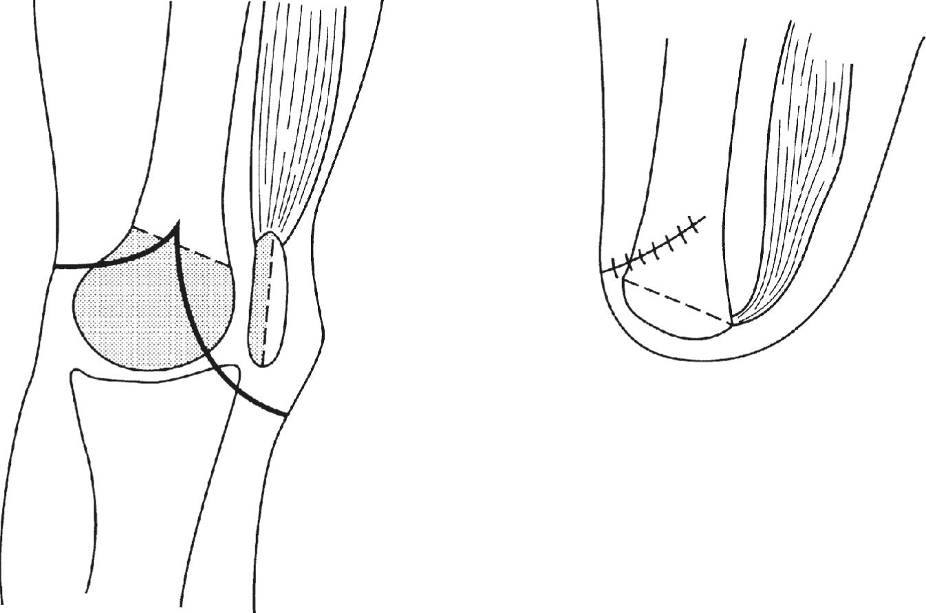 Figure 6.2, Transection of the femur with reverse angle results in a more stable attachment of the patella in the Gritti–Stokes amputation.