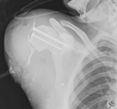 Fig. 72.11, Anterior-posterior radiograph of a proximal right transhumeral amputation treated with concomitant glenohumeral arthrodesis to prevent late humeral head dislocation.