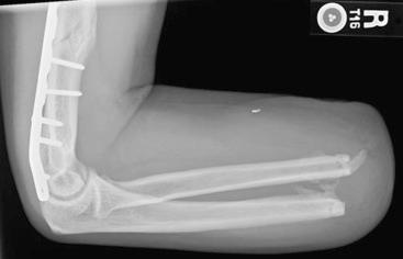 Fig. 72.12, Heterotopic ossification is common with traumatic amputations from combat injuries. It is common for symptomatic or functionally limiting heterotopic ossification to require surgical excision.