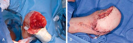 Fig. 72.2, Salvage of joint level. (A) Short transradial amputation level requiring soft tissue coverage to preserve the elbow joint. (B) A free anterolateral thigh flap was performed to provide durable distal amputation coverage. The remaining wound was covered with a skin substitute followed by staged split-thickness skin grafting.