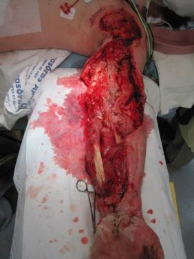 Fig. 72.5, Preoperative clinical photograph of a mangled left upper extremity with open fractures, vascular compromise, and multiple injuries and loss of soft tissue coverage, ultimately requiring transhumeral amputation.