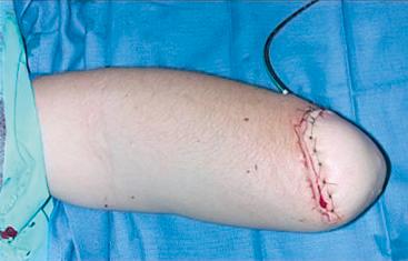 Fig. 72.7, Previous transradial amputation closure.