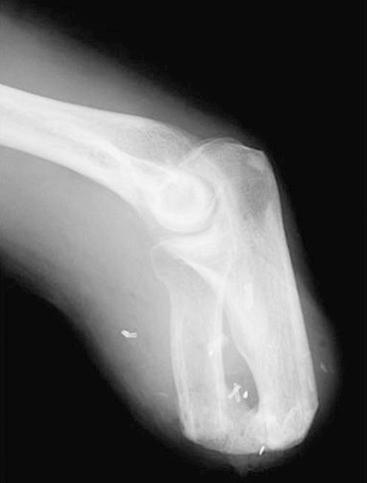 Fig. 72.8, Very short transradial amputation. Elbow flexion is preserved, but heterotopic ossification prevents forearm rotation.