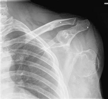 Fig. 72.10, Very short transhumeral amputation with dislocation of the humeral head. Arthrodesis can retain shoulder contour and prevent painful subluxation or dislocation.