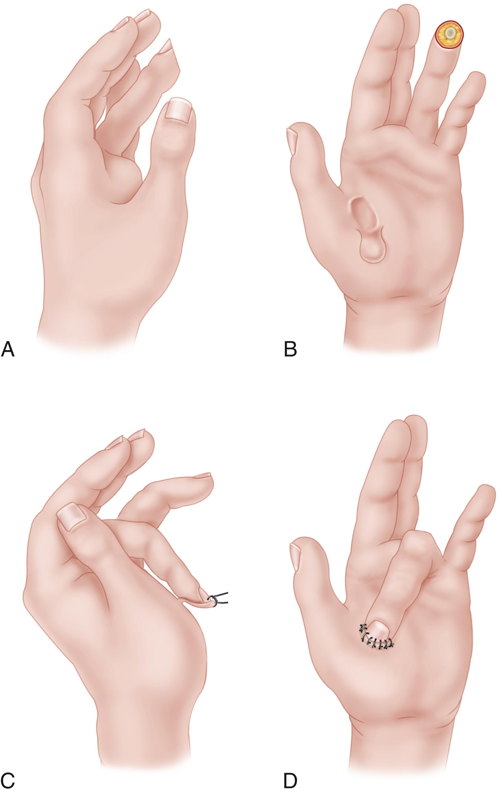 FIGURE 19.15, Thenar flap for amputation of fingertip. A, Tip of ring finger has been amputated. B, Finger has been flexed so that its tip touches middle of thenar eminence, and thenar flap has been outlined. C, Split-thickness graft is to be sutured to donor area before flap is attached to finger. D, End of flap has been attached to finger by sutures passed through nail and through tissue on each side of it. SEE TECHNIQUE 19.5 .