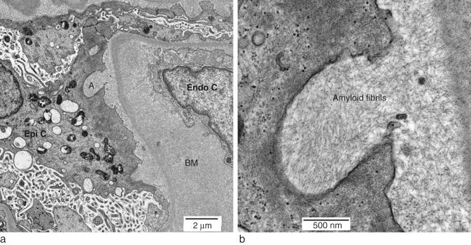 Fig. 15.2, (a) Electron micrograph of kidney from a case of amyloidosis with renal involvement showing amyloid (A), epithelial cytoplasm (Epi C), basement membrane (BM) and an endothelial cell (Endo C). (b) A higher magnification of Fig. 15.2a where amyloid fibrils can be clearly seen.