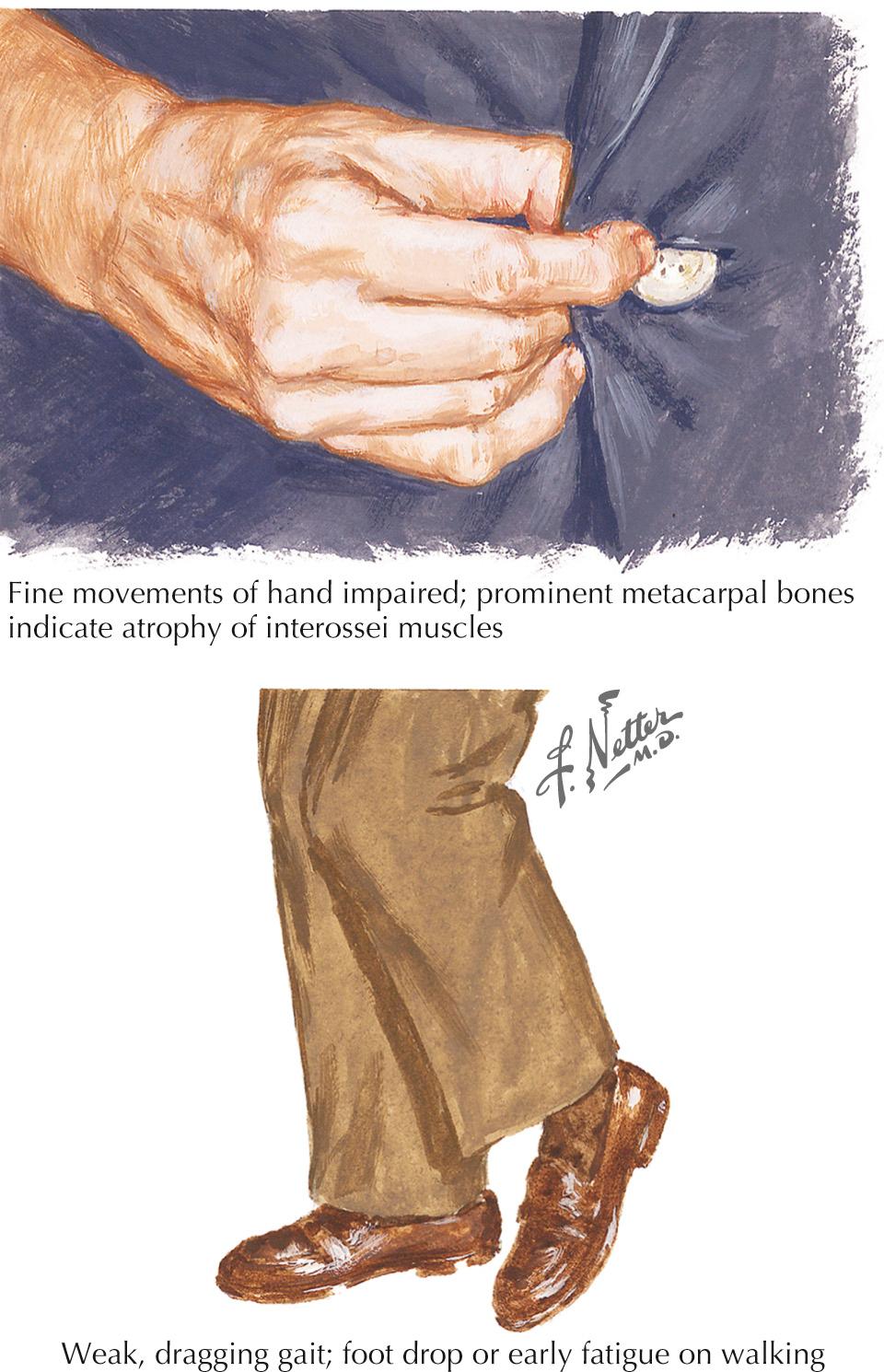 Fig. 62.3, Motor Neuron Disease: Early Clinical Manifestations.